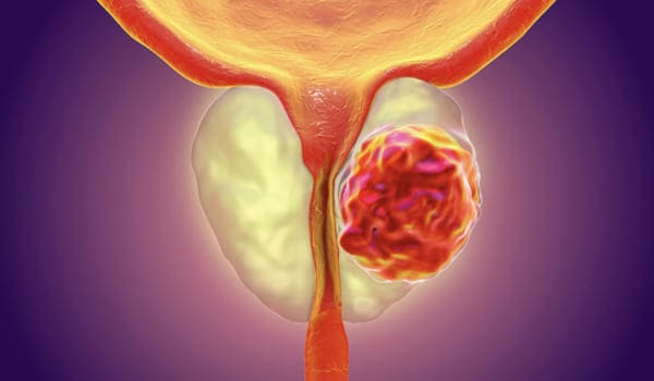 Cáncer de Próstata