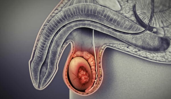 Cáncer de Testículo