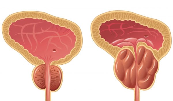 Hiperplastia Prostática Benigna (HPB)