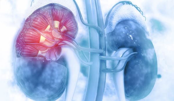 Nefrectomía Radical